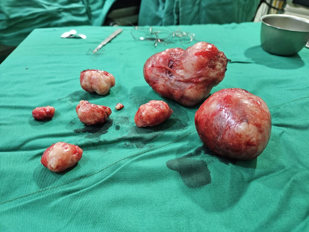 Miomas retirados após uma miomectomia
