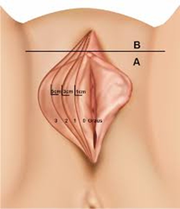 Classificação da hipertrofia dos pequenos lábios