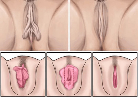 Desenho esquemático do procedimento de ninfoplastia