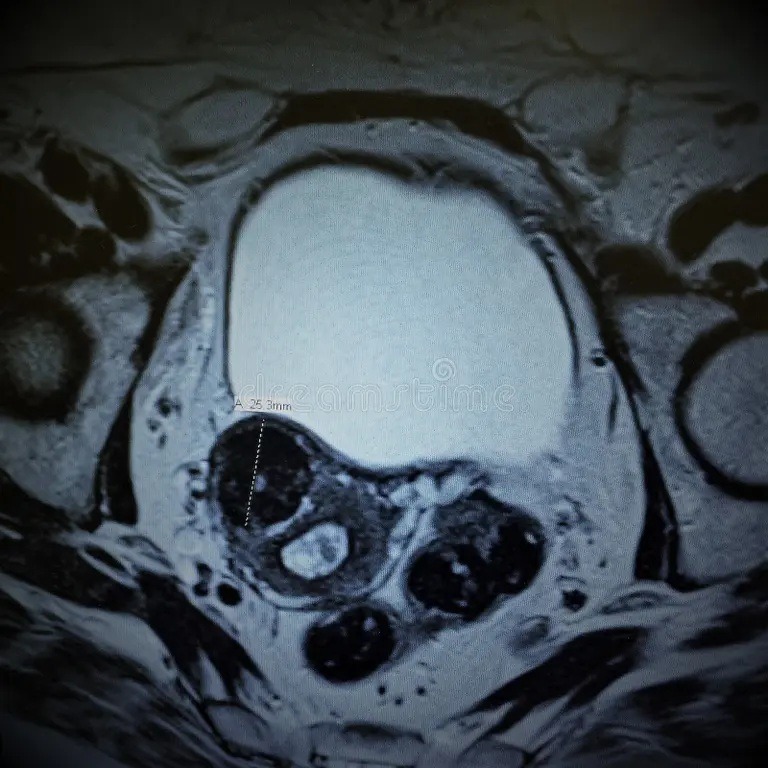 Diagnóstico miomas uterinos