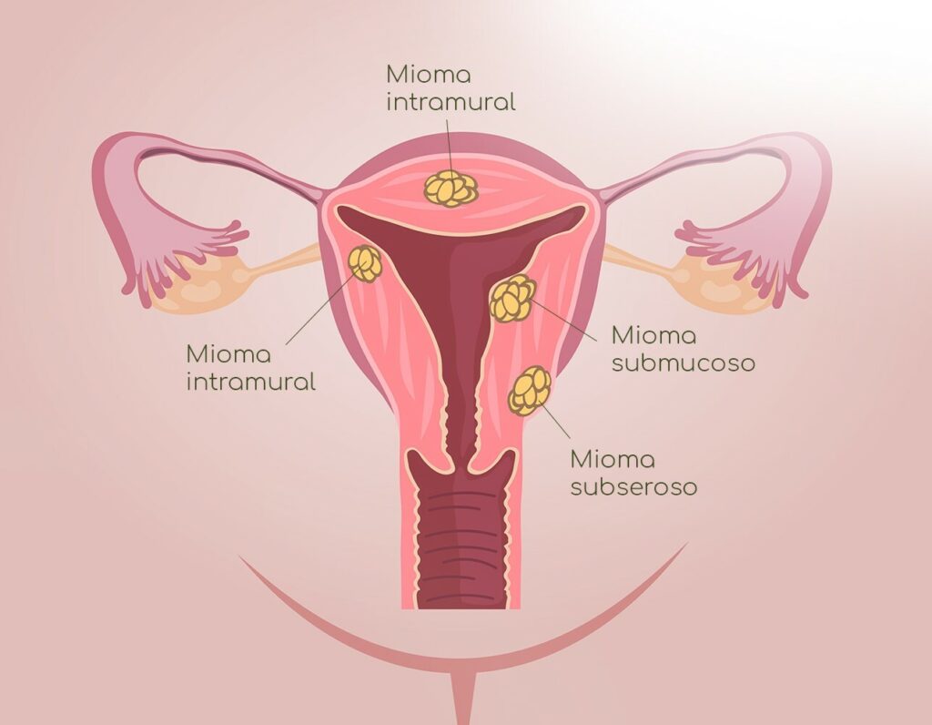 Tipos de miomas uterinos: submucoso, intramural e subseroso